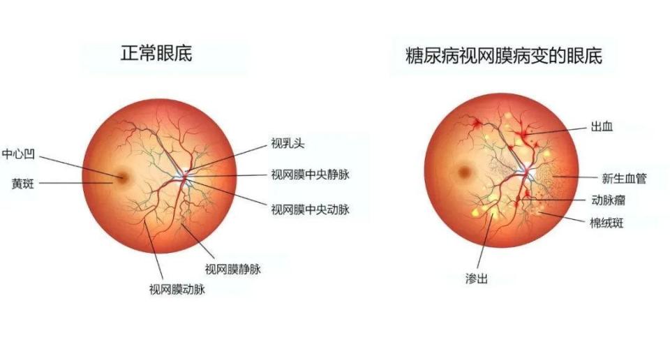 糖尿病发生视网膜病变,可能会失明!记住!糖尿病治疗要趁早!