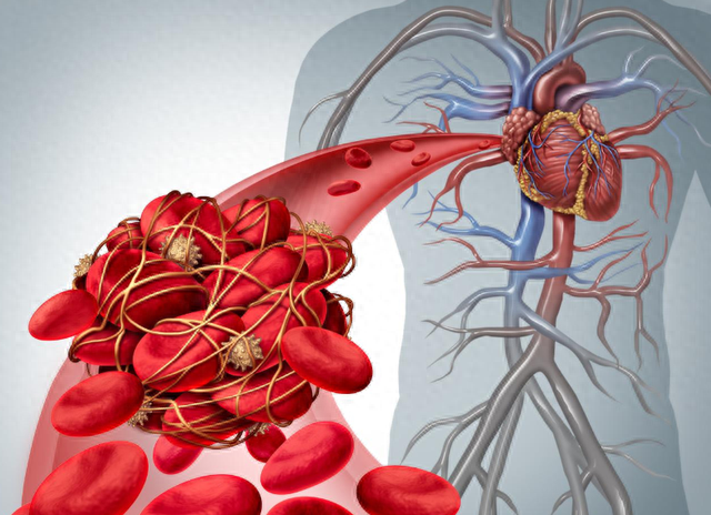 为何静脉血栓找上你?做好5个预防,守护你的血液健康_腾讯新闻