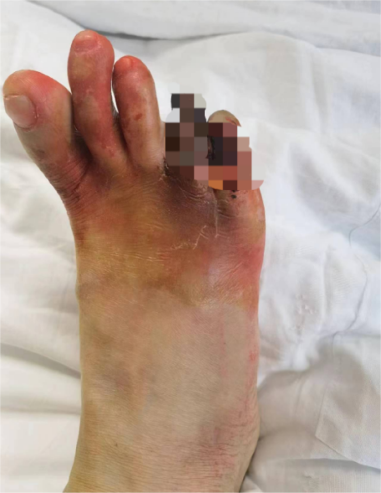 老伯足趾破溃夜不能寐烂脚趾面临截肢风险专家半夜抽筋痛醒不一定是
