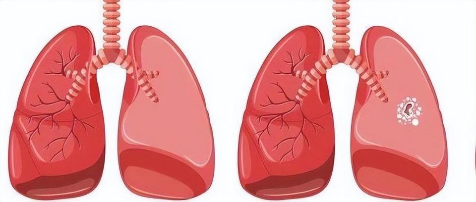 正常肺与肺结核图片图片