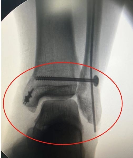 2月13日晚,33岁的孔先生在下楼时不小心踏空失去平衡,崴伤左脚腕,当即