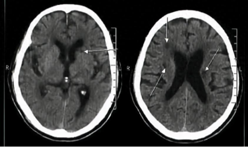 其实,腔隙性脑梗塞就是脑梗死的一种,因为梗死的面积很小,一般不彻