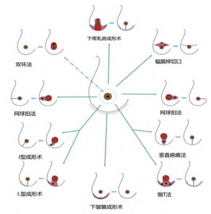 科普时光 | 张赟建教授:保乳开启乳腺癌治疗新篇章,实现美丽与健康
