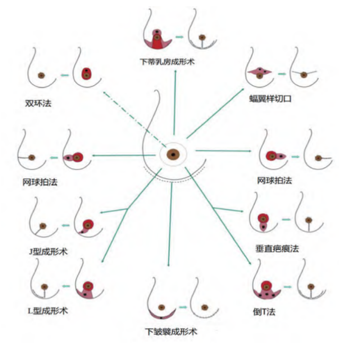 一般而言,乳房越小,手术难度越高,且术后常需借助整形手段以重塑乳房