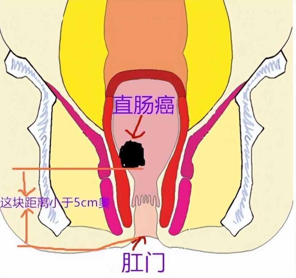 直肠癌患者越来越多年轻化,早期会出现哪些症状?如何正确预防?
