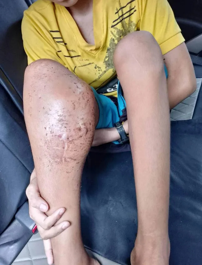 膝盖肿如"馒头"!缅北歪莫男孩患骨癌,急需各界爱心人士帮助