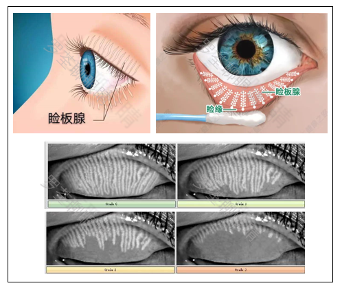 睑板腺在上下眼皮里面,有很多根,开口在睑缘,即睫毛根部附近(图片来源