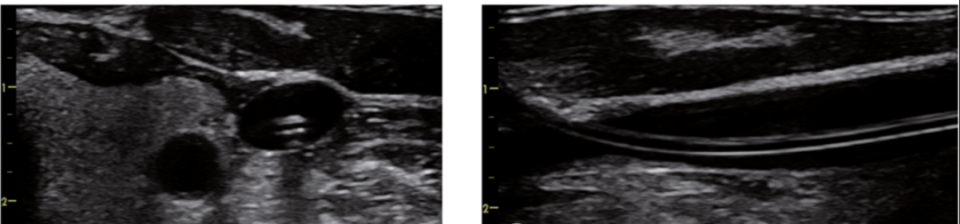 导丝怎么扩规培临床技能：中心静脉置管术全攻略之超声引导下锁骨下静脉穿刺置管术（8）_https://www.jmylbn.com_新闻资讯_第13张
