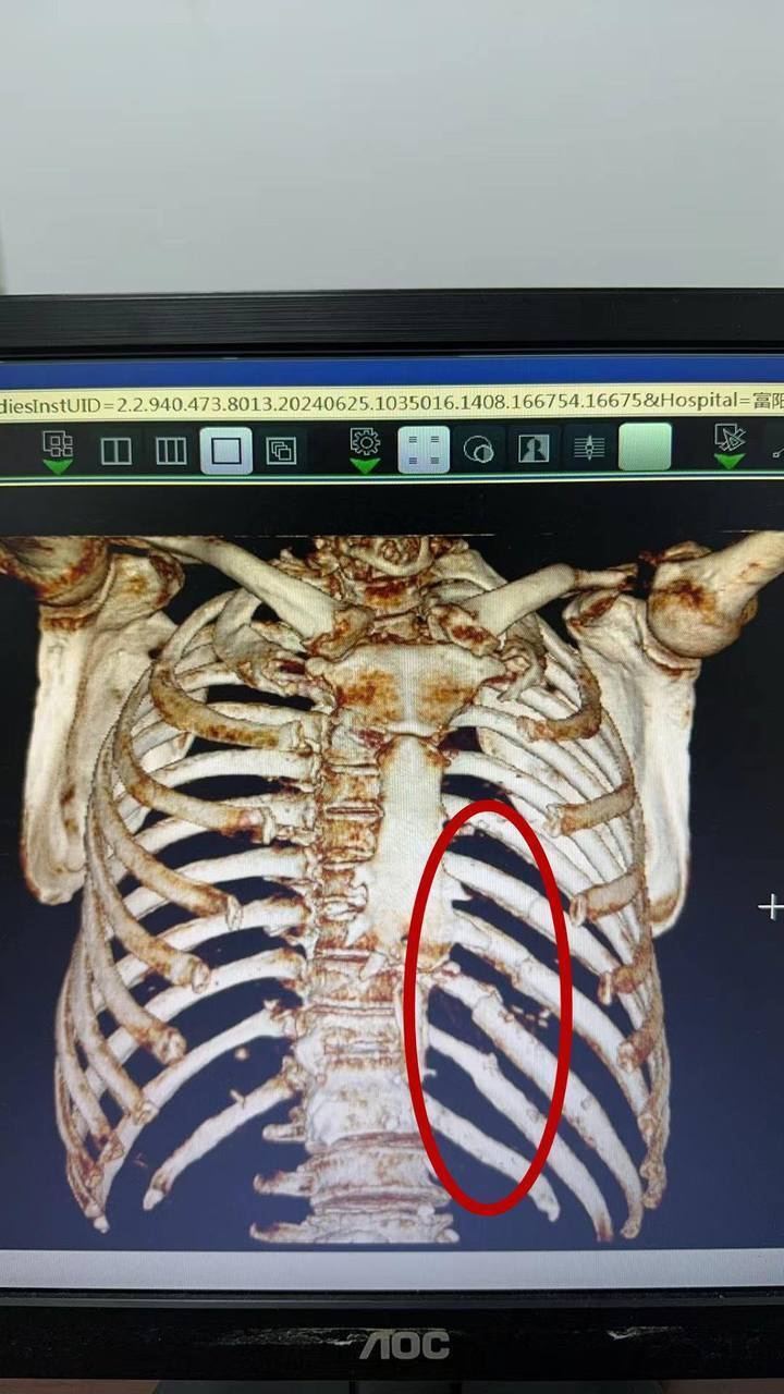 右侧第九肋骨骨折图片图片