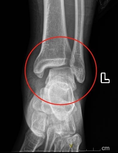 男子踩空台阶崴脚没重视险致残医生扭伤脚脖子别仅凭感觉判断轻重