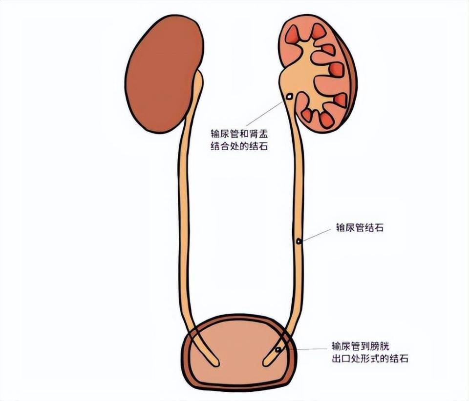 输尿管结石了？怎么办？如何治疗与预防？_腾讯新闻