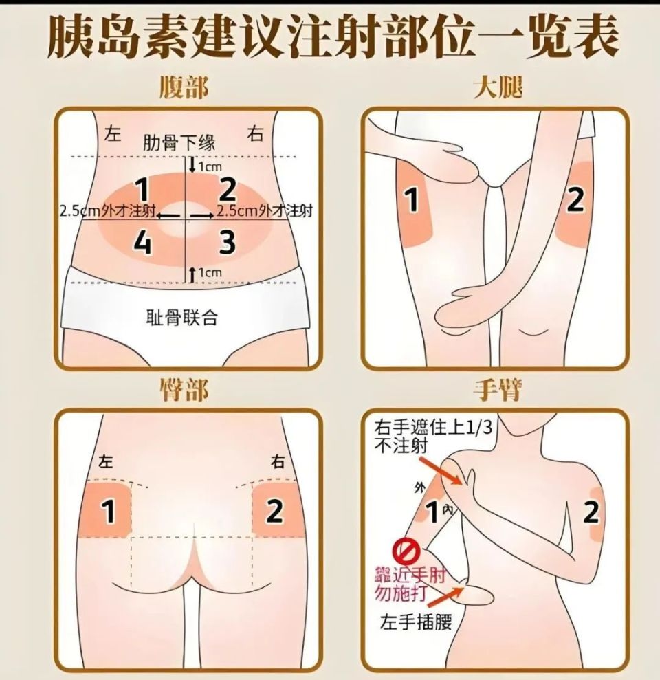 打胰岛素正确部位图图片