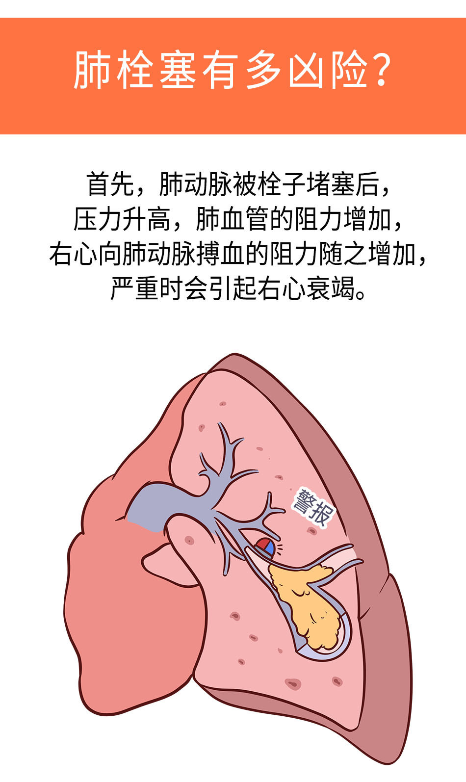 《棉签医学科普》北京安贞医院,急诊危重症中心,米玉红肺栓塞,肺部