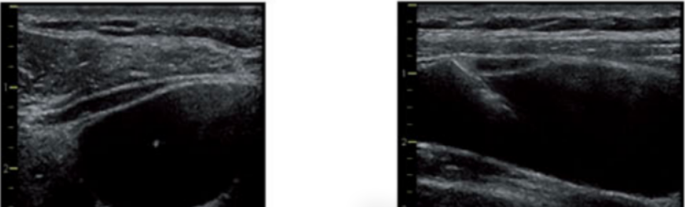 导丝怎么扩规培临床技能：中心静脉置管术全攻略之超声引导下锁骨下静脉穿刺置管术（8）_https://www.jmylbn.com_新闻资讯_第11张