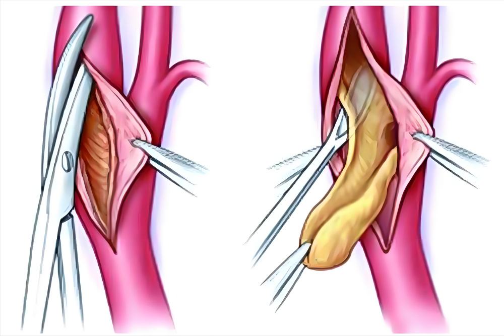 颈动脉外膜剥脱术图片