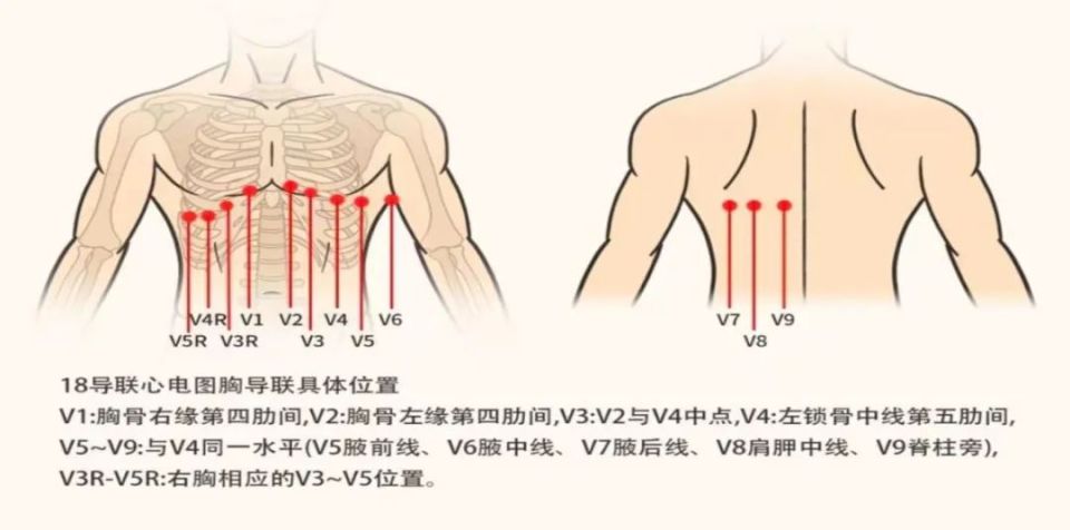 心梗心电图定位九宫格图片