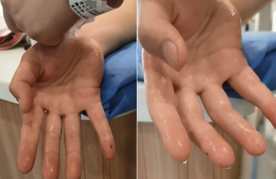 距高考仅1个月女孩决定手术!专家:6大症状警惕手汗症_腾讯新闻