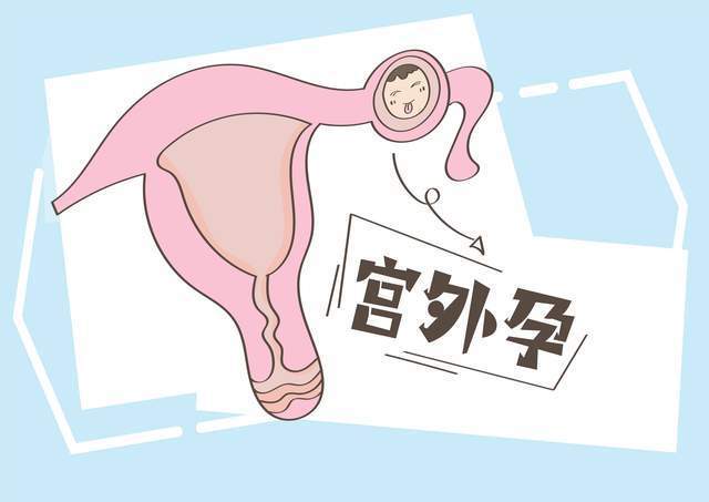 宮外孕到底什麼原因引起的做好這5項預防守護女性健康