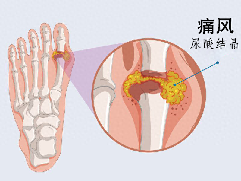 痛风反复发作?可能饮食有问题!医生提示:4个饮食原则要注意!