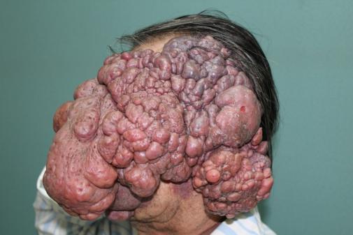 空军军医大学口腔医院成功完成一例颌面部巨大脉管畸形修复重建病例