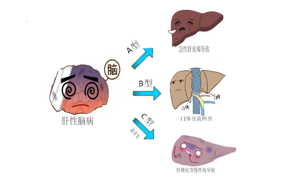 肝性脑病诱因图片