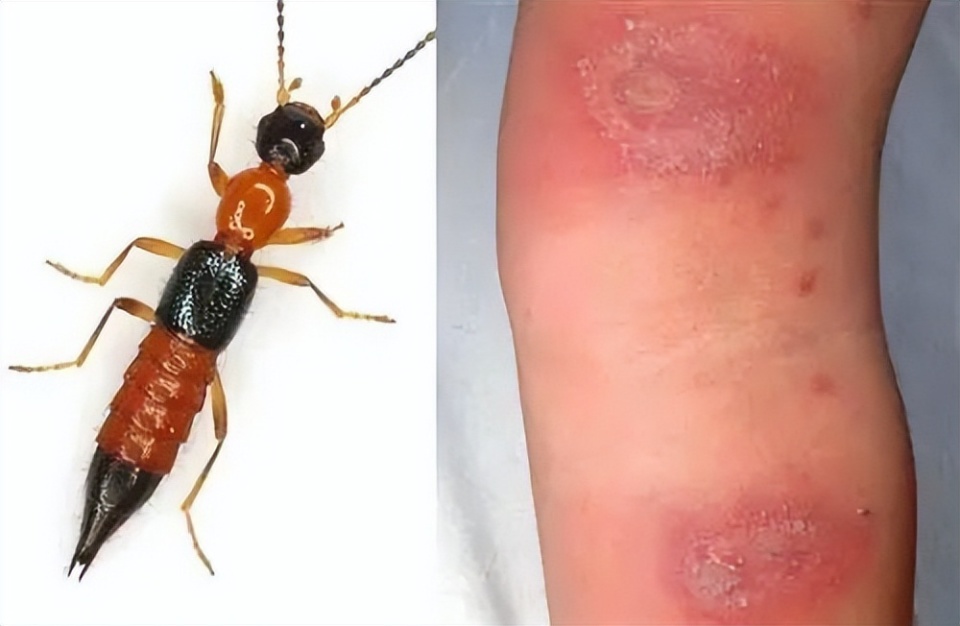 毒性隐翅虫数量增多!千万别用手拍,接触毒液后果严重,该如何防范?