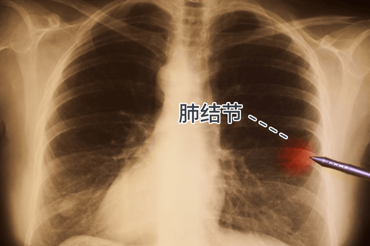 肺结节怎么回事?做好早期筛查,防止恶性结节