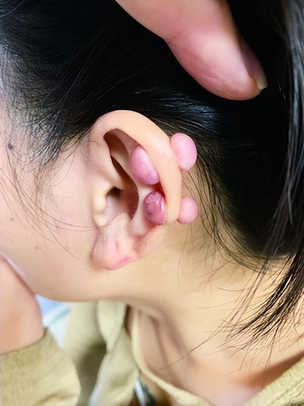耳洞增生怎么辨别图片