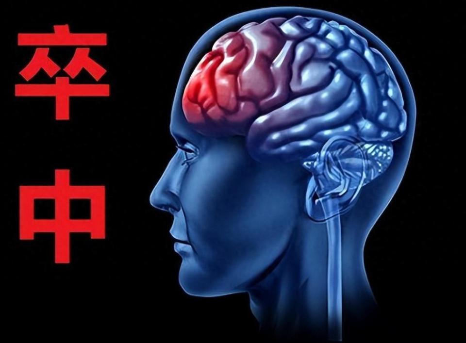 卒中的5个先兆要注意抵御卒中做好这4点