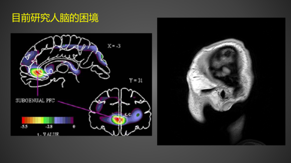 脑核磁共振怎么看图片