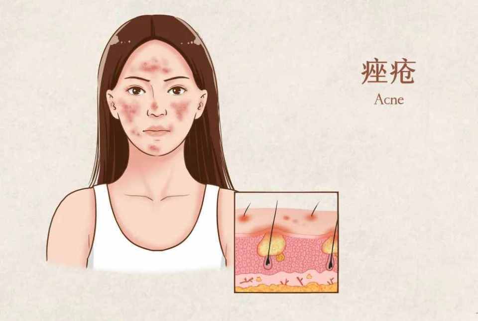 经常起痘反复发作可能是痤疮在作怪日常改变这些生活方式