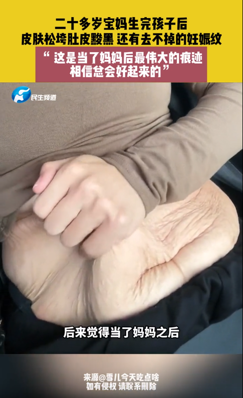 20多岁宝妈晒产后满是妊娠纹的肚子网友好吓人大多数都不是这样的