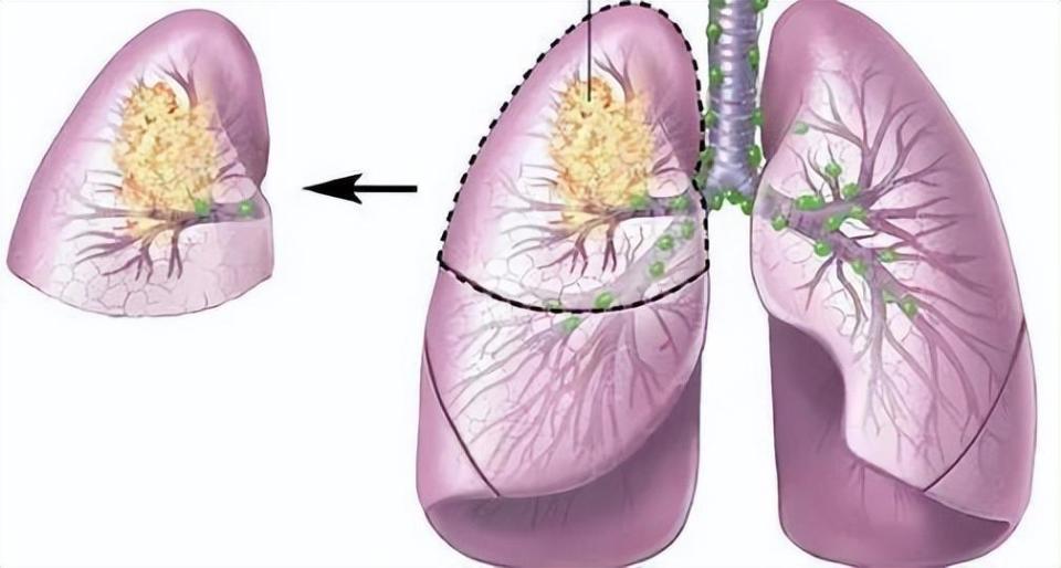 得了肺结节?别紧张!做好这些筛查,看看你是哪一类!_腾讯新闻