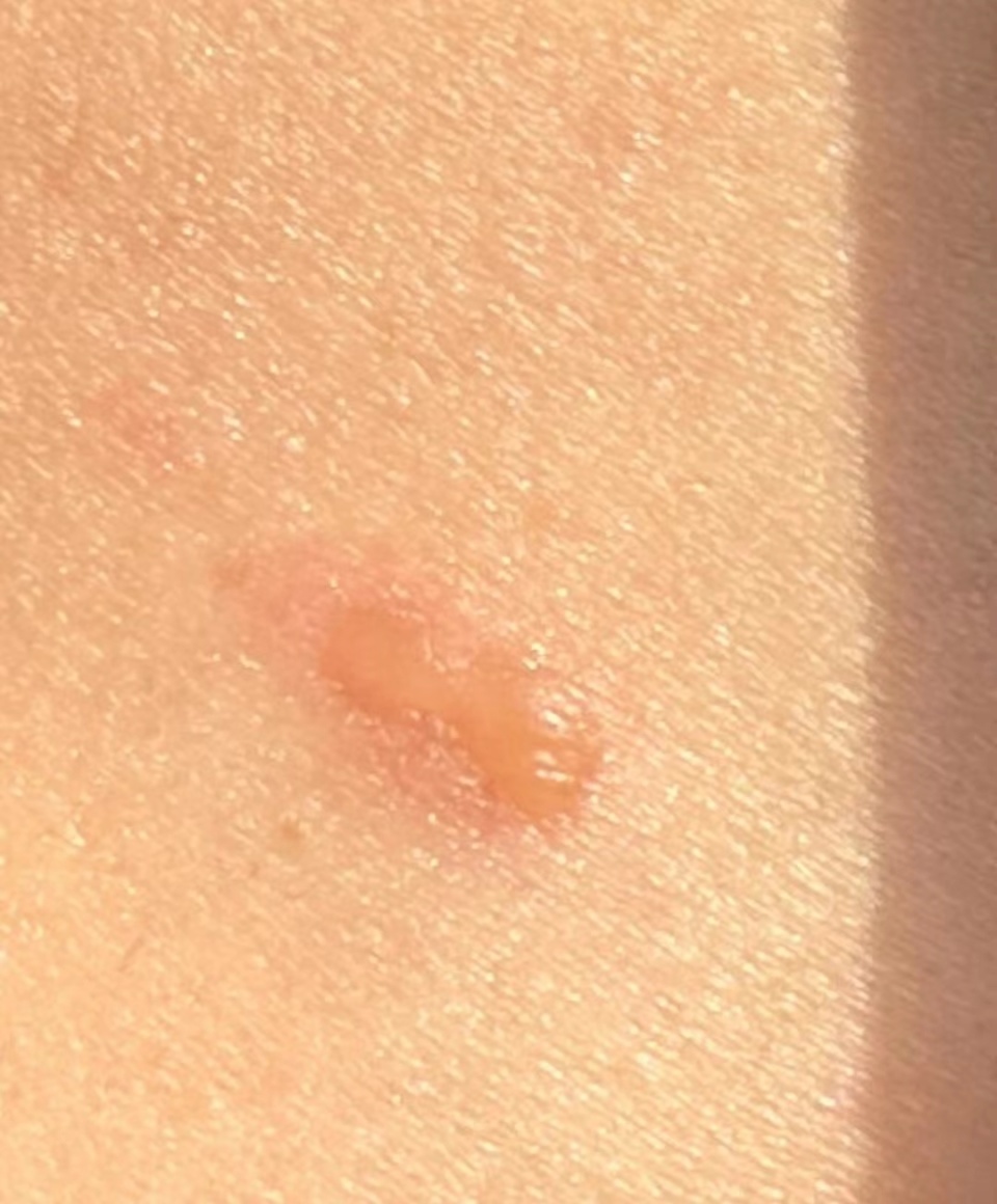 胸口部位也肉眼可见的变红,局部皮肤还被烫出了小水泡