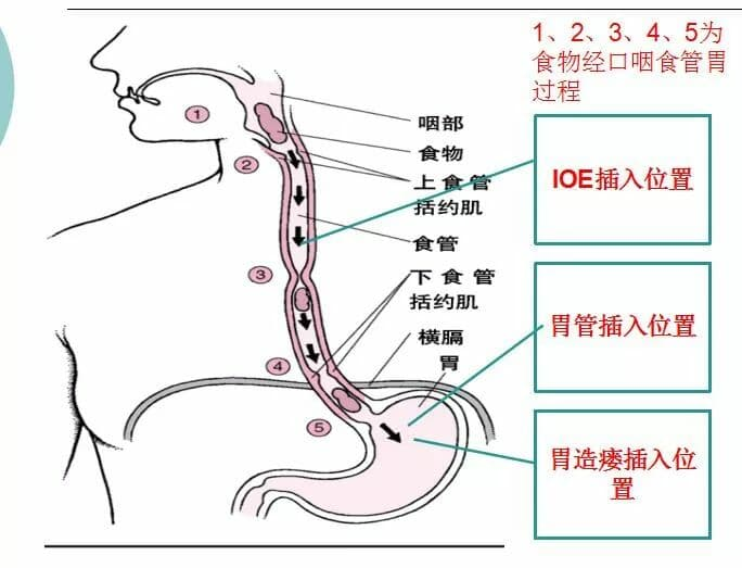 IOE技术: 让吞咽障碍患者摆脱“大象鼻”_腾讯新闻