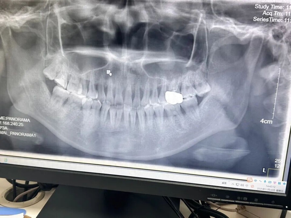 刚刚才20多岁的年纪，一口牙齿就快掉光了