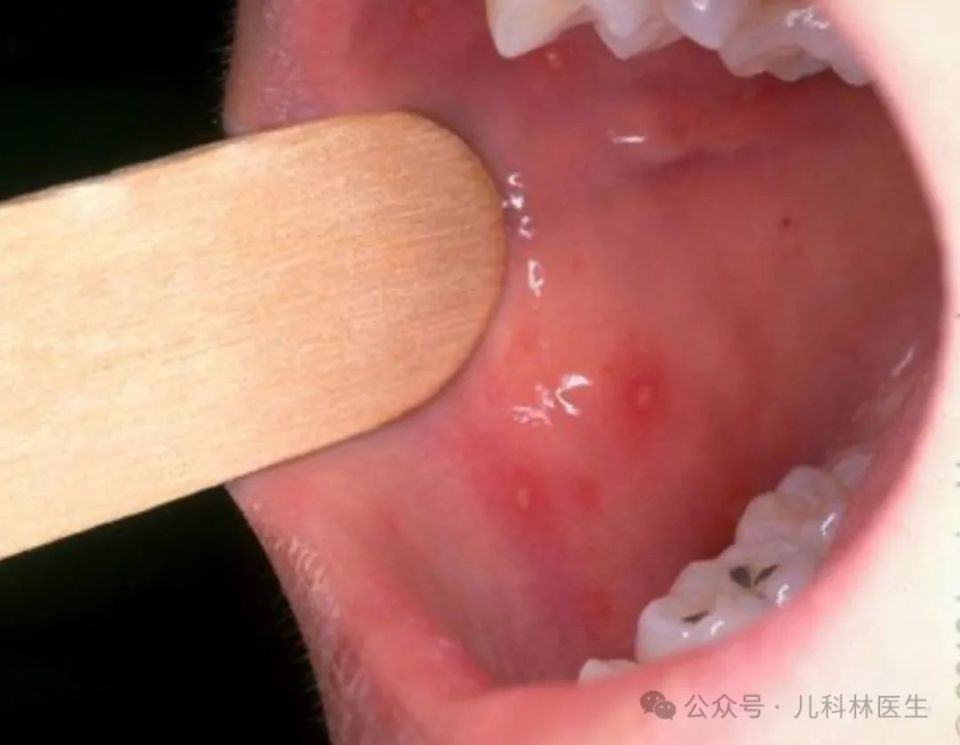 手足口病开始流行,怎么判断孩子是不是?感染了怎么办?