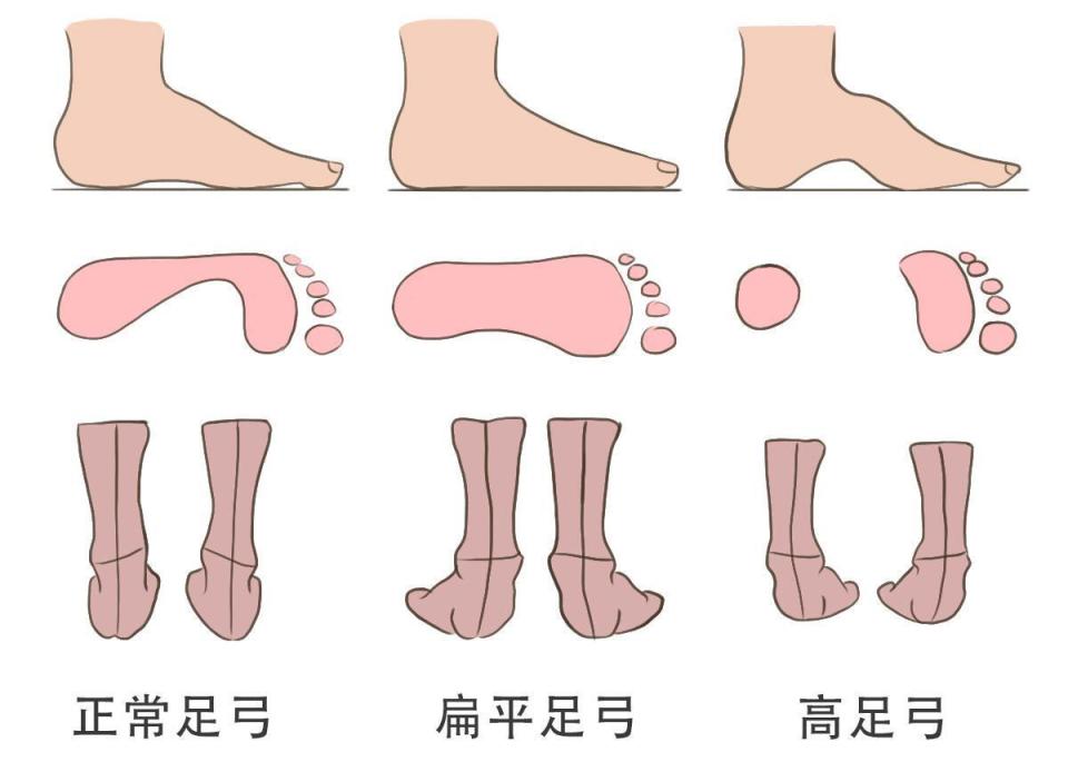 什么是加用治疗起床第一步脚后跟刺痛？大概率是足底筋膜炎！一文教你自查与自救_https://www.jmylbn.com_新闻资讯_第2张