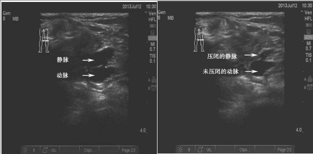 导丝怎么扩规培临床技能：中心静脉置管术全攻略之超声引导下锁骨下静脉穿刺置管术（8）_https://www.jmylbn.com_新闻资讯_第4张