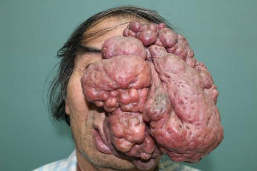 空军军医大学口腔医院成功完成一例颌面部巨大脉管畸形修复重建病例