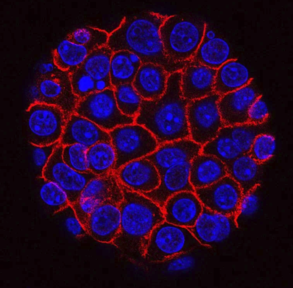 胰腺癌新药“达拉西布”三期数据亮眼 中位生存期翻倍延长