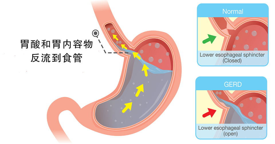 长期出现这些症状，可能胃食管反流引起的，这几类高发人群要注意_腾讯新闻