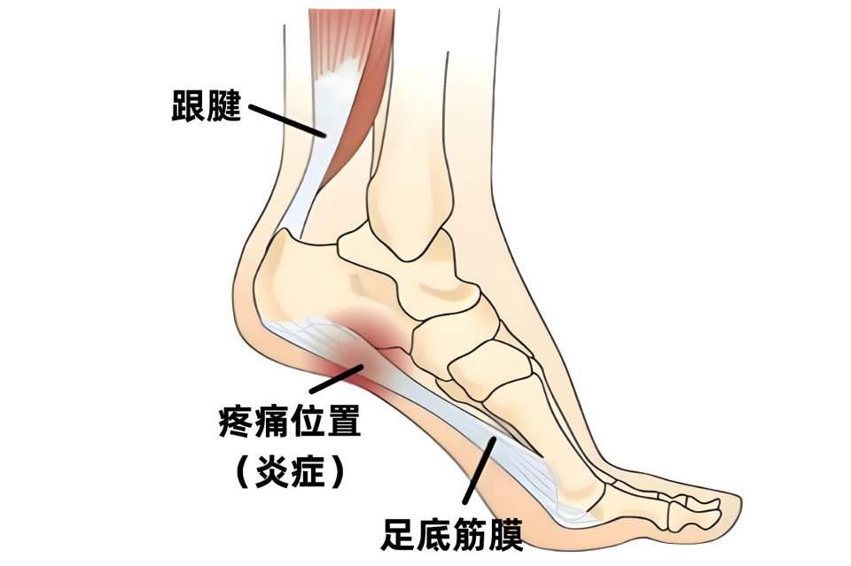经常脚后跟疼别大意,或与5种疾病有关!小心久拖不治变"废"人