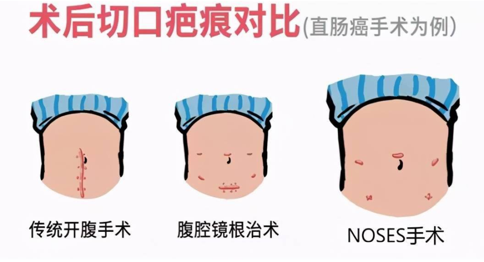 治疗直肠癌不切肚子,不"挂袋"