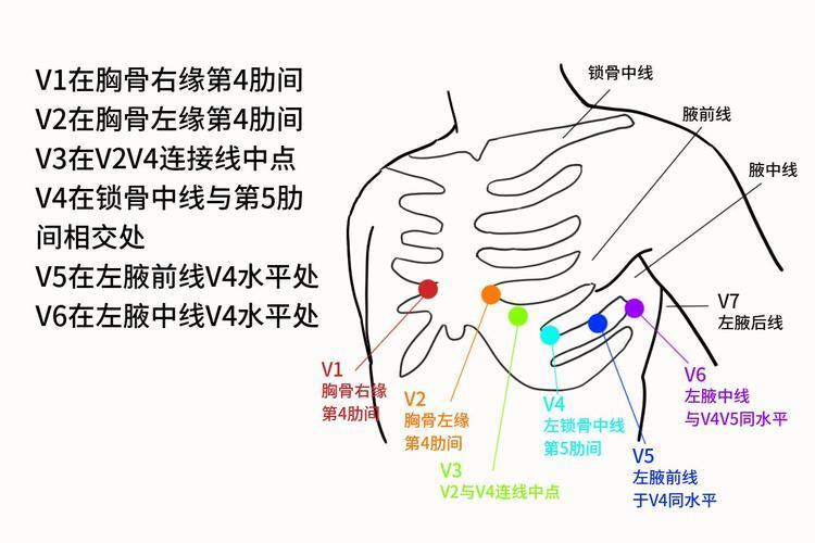 怀疑心肌梗死及时就医 十八导联心电图来帮你