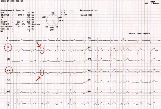 窦性心律是什么心律?