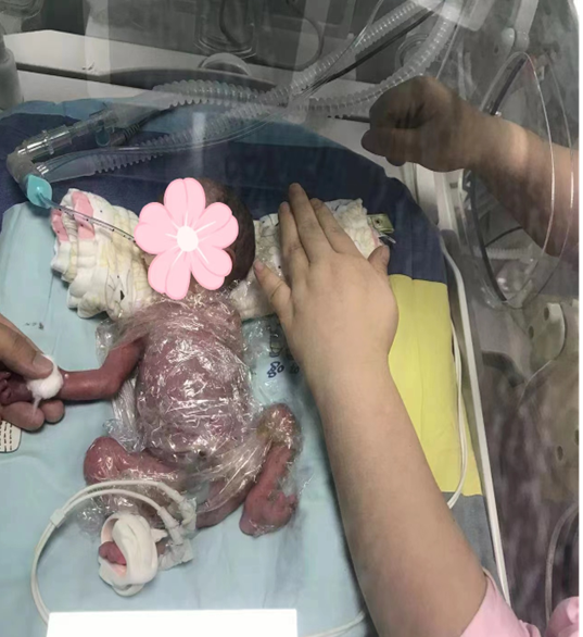 黄陂区人民医院精心救治,28周超早产宝宝闯关55天平安出院