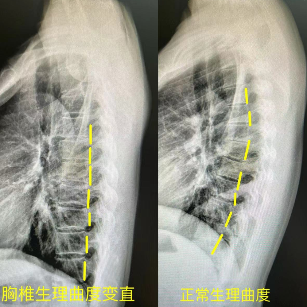 胸椎生理曲度变直，怎么办？2个动作练出脊柱健康曲度_腾讯新闻