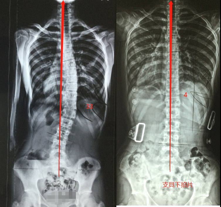 脊柱侧弯超过30°,怎么才能恢复的快?医生用一篇案例告诉您