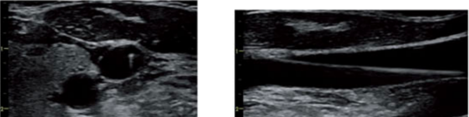 导丝怎么扩规培临床技能：中心静脉置管术全攻略之超声引导下锁骨下静脉穿刺置管术（8）_https://www.jmylbn.com_新闻资讯_第12张